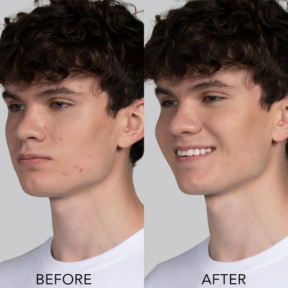 ESPADA 2 Acne Therapy LED Light Device